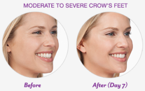 before & after anti-wrinkle injection around crow's feet