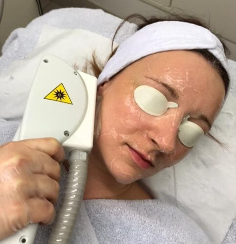 lady having IPL on her face with the eyes covered for protection