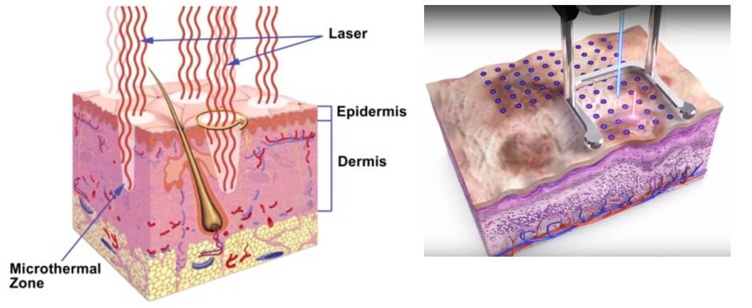 graph laser beam causing controlled trauma to the surface of the skin