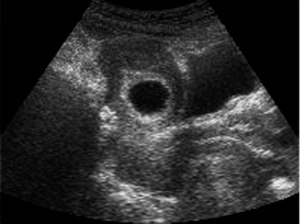 Fibroid in ultrasound
