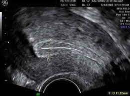 Uterine lining problems
