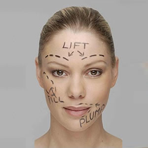 drawing on face to highlight areas that need lifting, plumped & rejuvenated