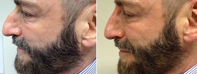 before & after non surgical nose job