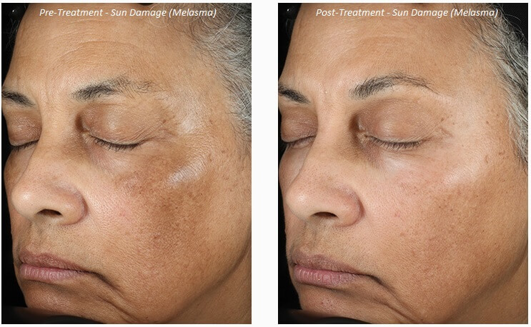 dark patches, Melasma, skin, Treatment
