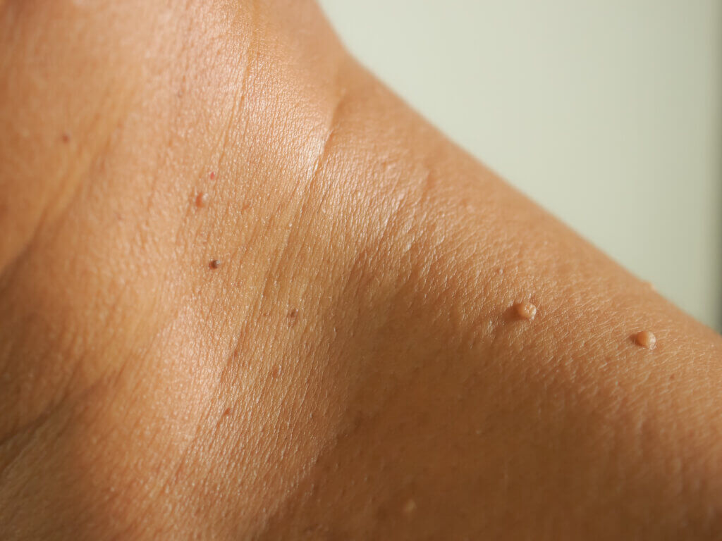 What Are Skin Tags & How To Get Rid Of Them?
