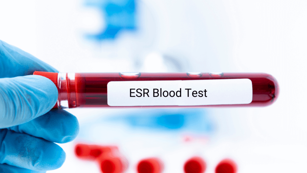 ESR Blood Test: What It Is and Why It Matters