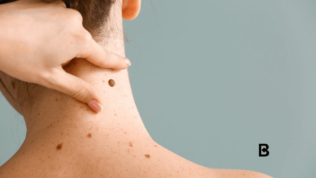 How Can I Get Moles Removed? All Your Questions Answered
