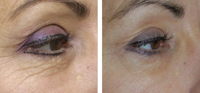 4 Ways to Boost Collagen and Skin Health